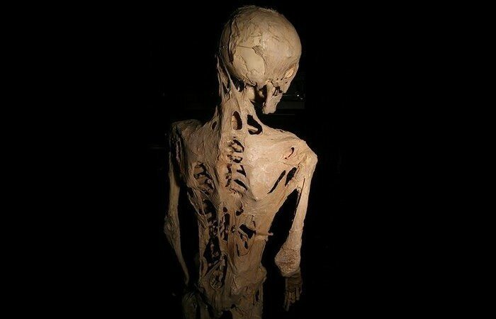 Фотография: Фибродисплазия — страшная болезнь, превращающая человека в костяного истукана №4 - BigPicture.ru