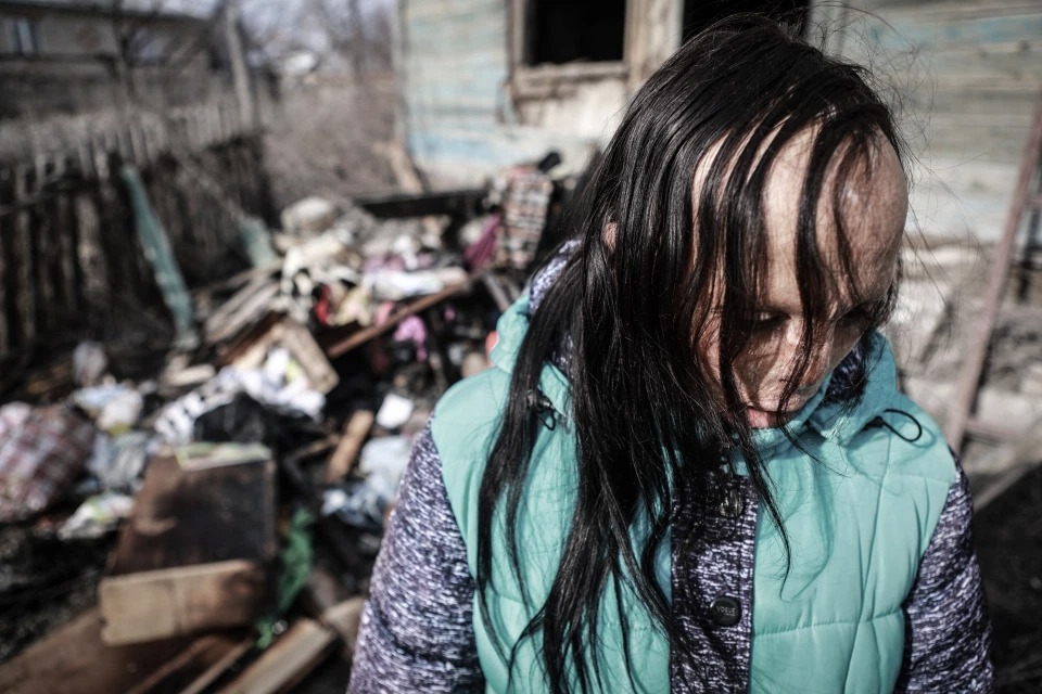 Фотография: История Ани Болдыревой, которая лишилась лица из-за пожара, но надеется на лучшую жизнь №3 - BigPicture.ru