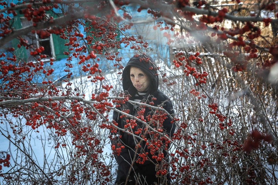 Фотография: История Ани Болдыревой, которая лишилась лица из-за пожара, но надеется на лучшую жизнь №1 - BigPicture.ru