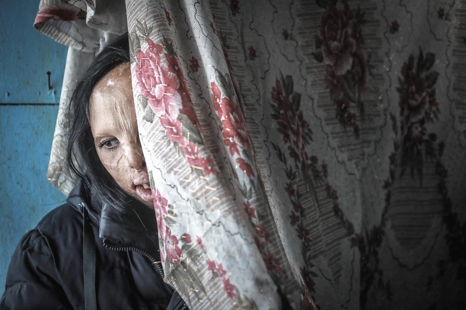 Фотография: История Ани Болдыревой, которая лишилась лица из-за пожара, но надеется на лучшую жизнь №4 - BigPicture.ru