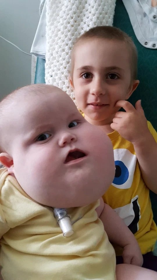 Фотография: С верой в лучшее: 4-летний мальчик с опухолью на лице не унывает, несмотря на болезнь №5 - BigPicture.ru