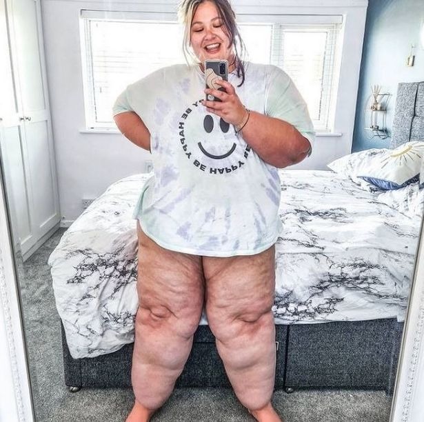 Фотография: Британка изнуряла себя диетами, чтобы ее ноги похудели, но это была болезнь №4 - BigPicture.ru