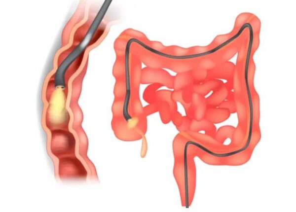 Бережное очищение кишечника перед колоноскопией: чем можно воспользоваться