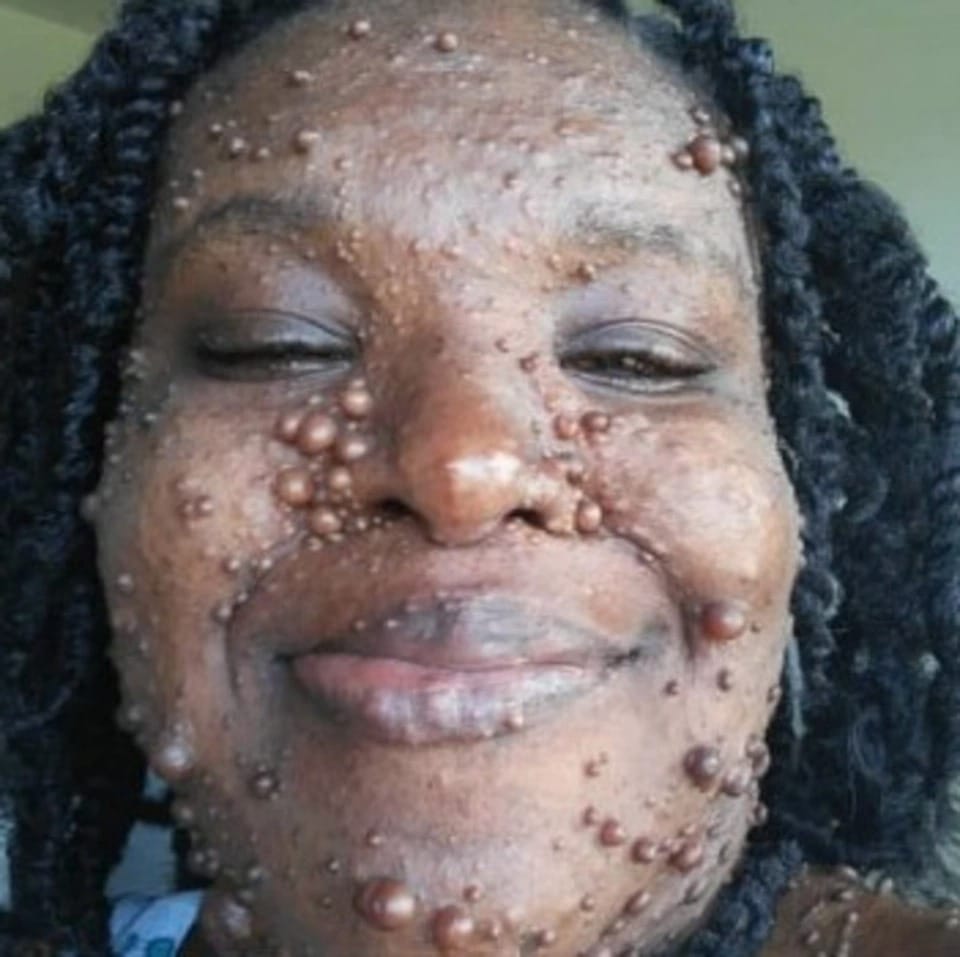 Фотография: Американка, тело которой покрыто двумя сотнями опухолей, обрела уверенность в себе благодаря дочери №3 - BigPicture.ru