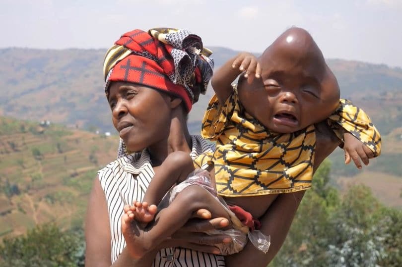 Фотография: Родственники отказались от африканки, которая родила малыша с головой в форме груши №3 - BigPicture.ru