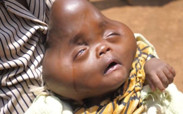 Фотография: Родственники отказались от африканки, которая родила малыша с головой в форме груши №2 - BigPicture.ru