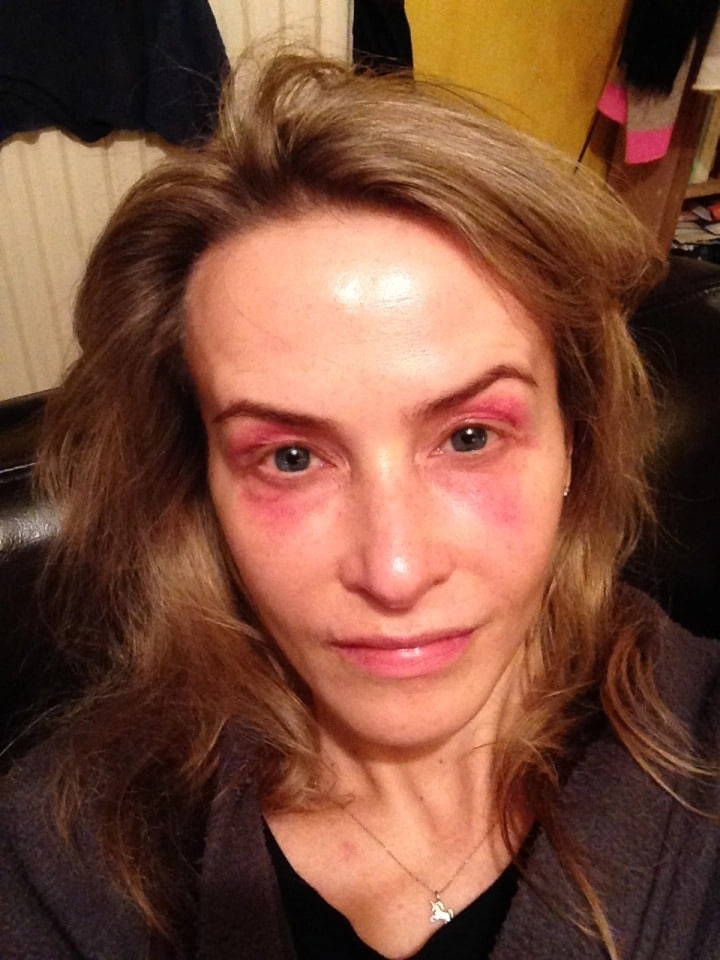 Фотография: На собственной шкуре: британка испытала на себе эффекты от модных косметологических процедур №7 - BigPicture.ru
