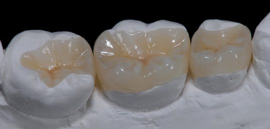Фотография: Современное протезирование - преимущества инновационных технологий в стоматологии №2 - BigPicture.ru