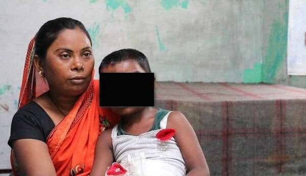 Девочку с двумя носами в Индии считают воплощением божества