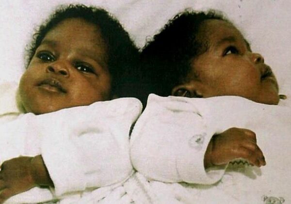 Разделенные в младенчестве сиамские близнецы продолжают спать так же, как до операции