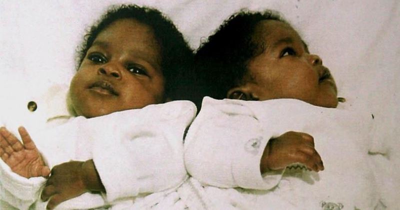 Фотография: Разделенные в младенчестве сиамские близнецы продолжают спать так же, как до операции №1 - BigPicture.ru