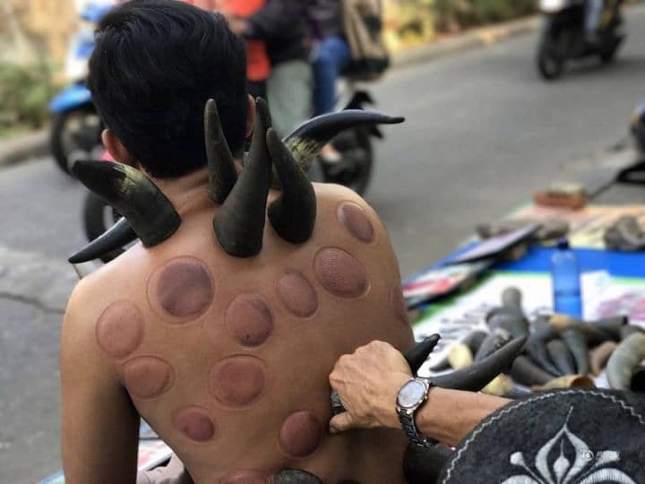 Фотография: Зачем в Индонезии уличные целители ставят рога на спину пациентам №2 - BigPicture.ru