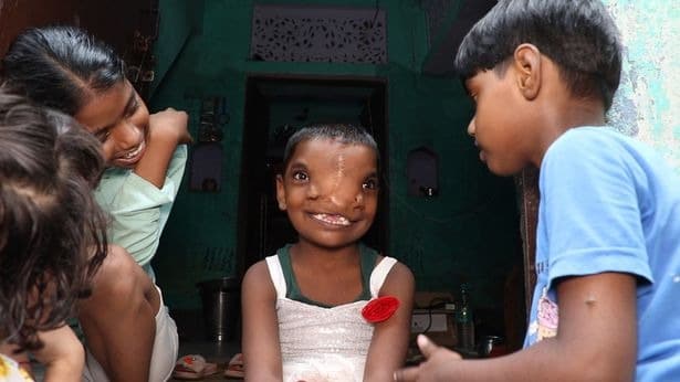 Фотография: Девочку с двумя носами в Индии считают воплощением божества №2 - BigPicture.ru