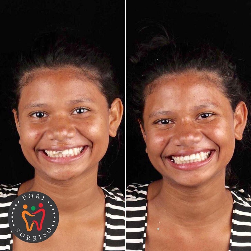 Фотография: 30 фото до и после того, как людям вернули улыбку №4 - BigPicture.ru