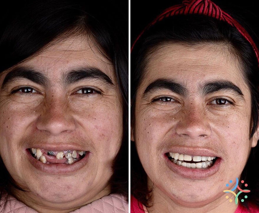 Фотография: 30 фото до и после того, как людям вернули улыбку №13 - BigPicture.ru