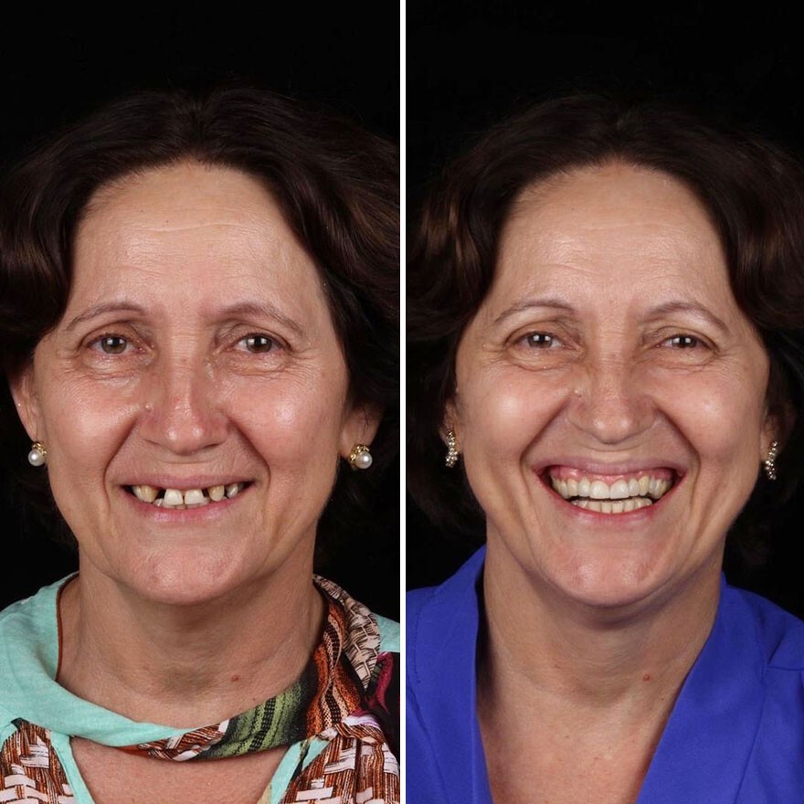 Фотография: 30 фото до и после того, как людям вернули улыбку №20 - BigPicture.ru