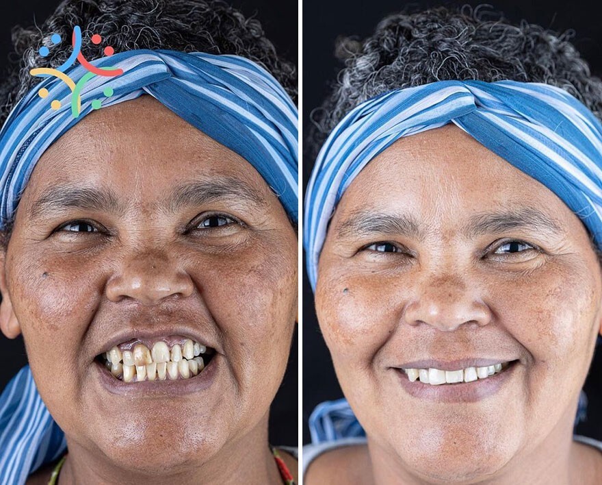 Фотография: 30 фото до и после того, как людям вернули улыбку №7 - BigPicture.ru