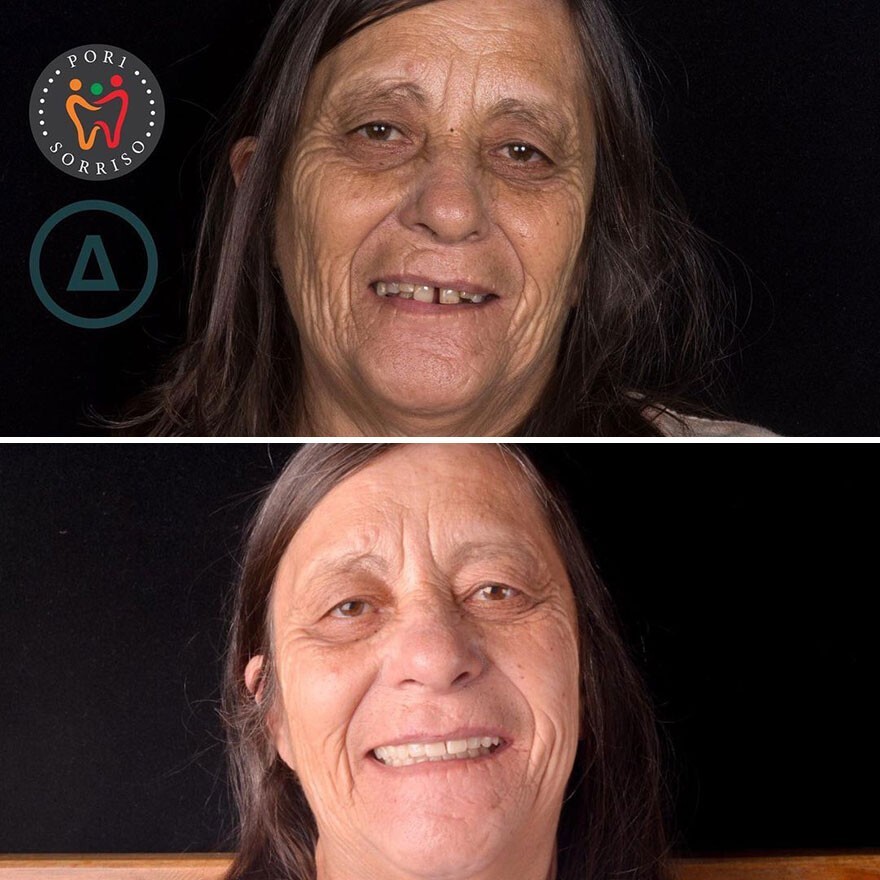 Фотография: 30 фото до и после того, как людям вернули улыбку №21 - BigPicture.ru