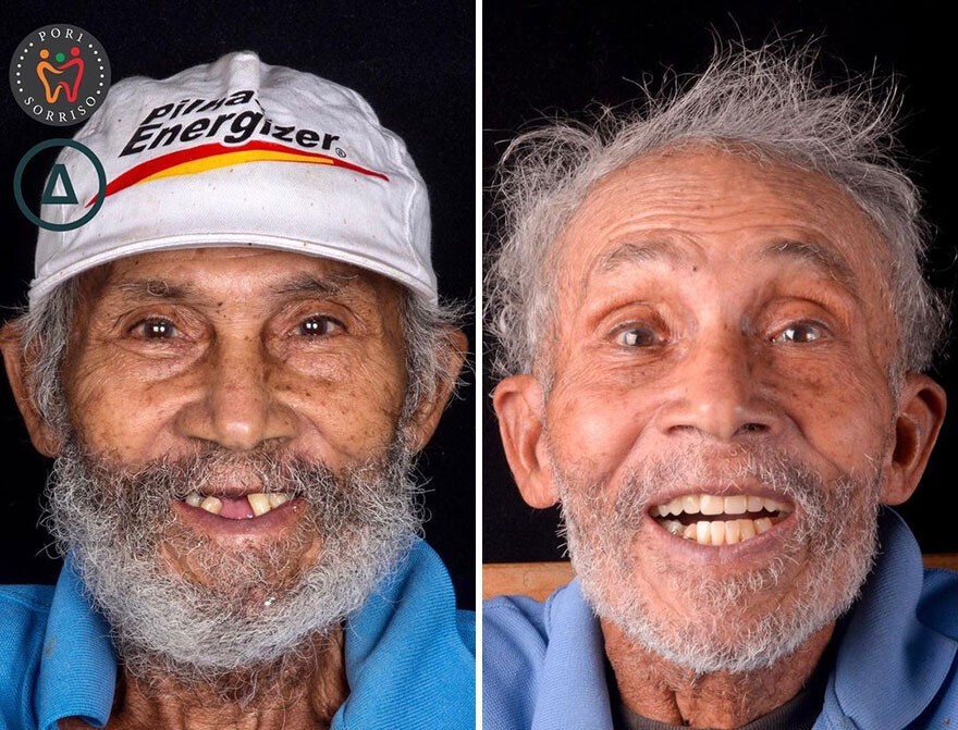 Фотография: 30 фото до и после того, как людям вернули улыбку №1 - BigPicture.ru