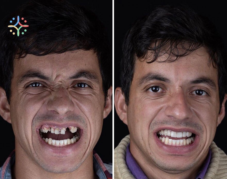 Фотография: 30 фото до и после того, как людям вернули улыбку №28 - BigPicture.ru