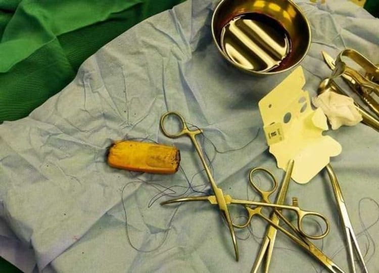 Фотография: Египетские врачи достали из кишечника пациента мобильник, который находился там полгода №4 - BigPicture.ru