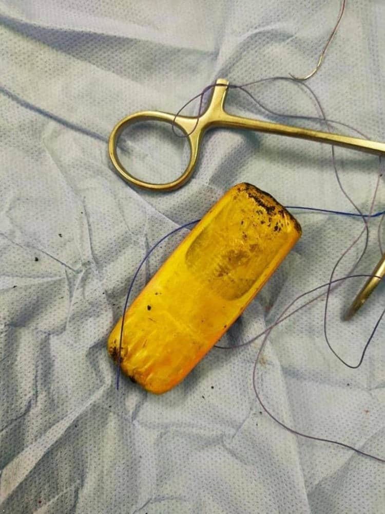 Фотография: Египетские врачи достали из кишечника пациента мобильник, который находился там полгода №2 - BigPicture.ru