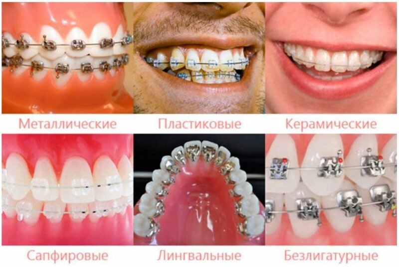 Фотография: Виды и особенности прикуса: что может повлиять №2 - BigPicture.ru