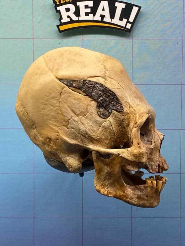 Скрепленный металлом 2000 лет назад человеческий череп поразил ученых