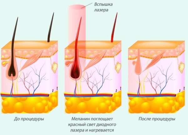 Все о длительности эффекта от лазерной эпиляции