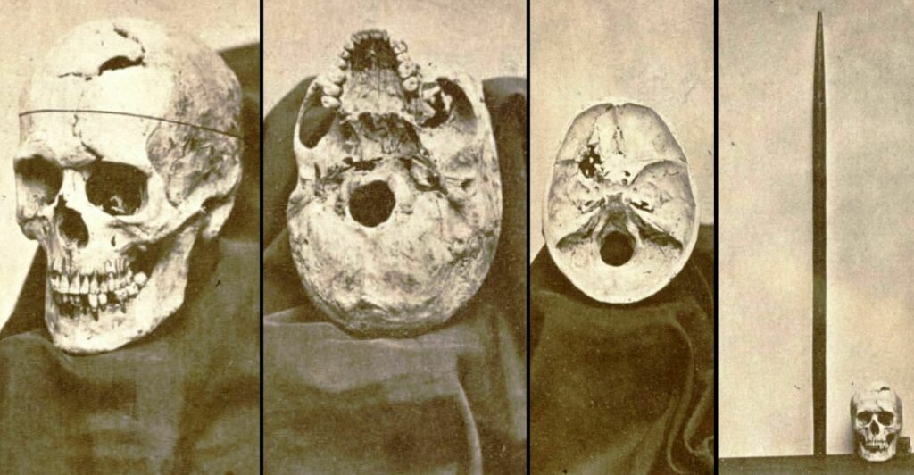 Bigpicture.ru Удивительная история Финеаса Гейджа - человека с ломом в черепе20210730 173727 compress68