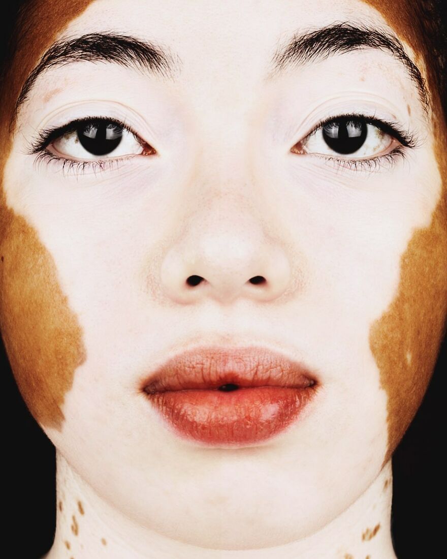 Портрет девушки с витилиго, прямой взгляд в камеру &mdash; серия Vitiligo, Брок Элбанк