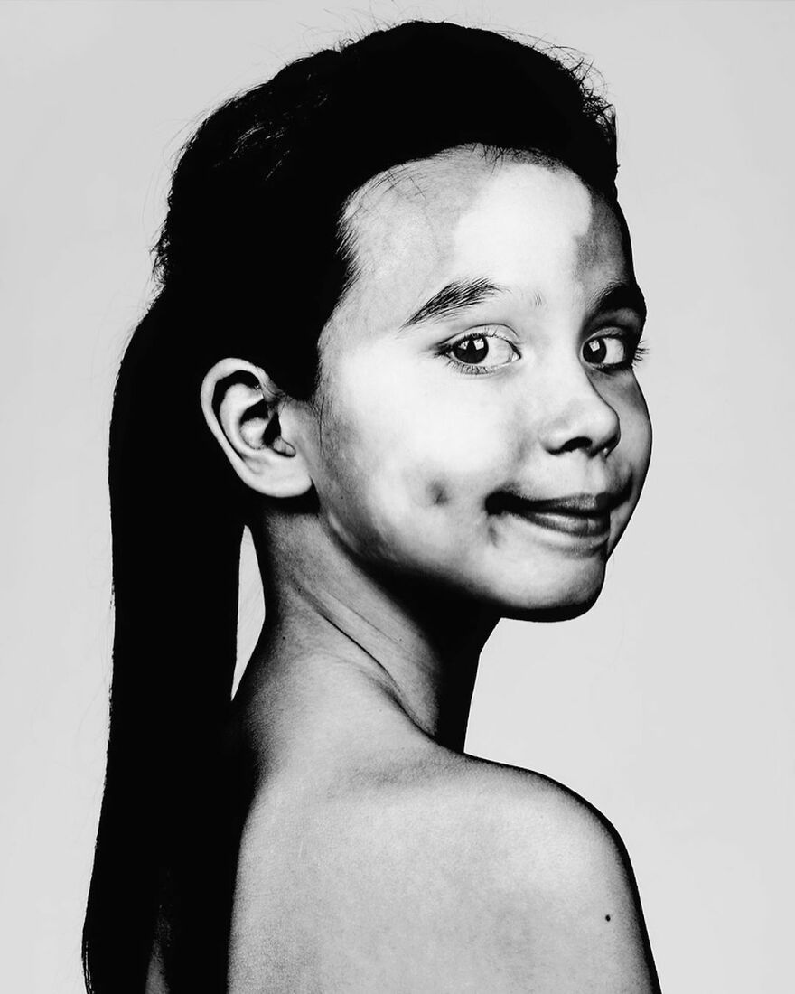 Девочка с витилиго и ямочками на щеках, уверенный взгляд в камеру &mdash; портрет Брока Элбанка