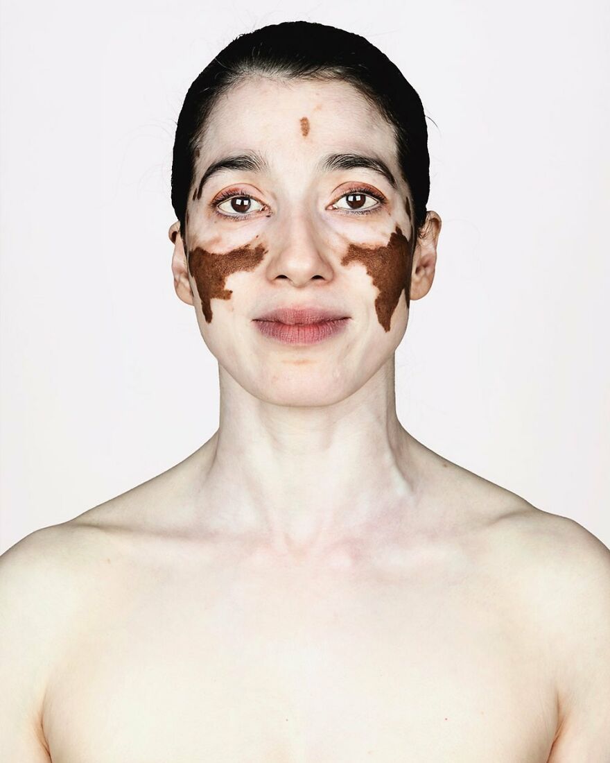 Белокожая женщина с тёмными пятнами на лице &mdash; портрет из серии нестандартной красоты Брока Элбанка