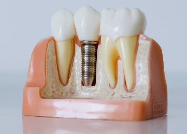 Имплантация зубов: полный анализ преимуществ и рисков