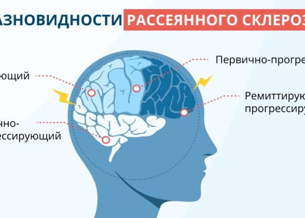 Рассеянный склероз в Московском центре: инновационные подходы к терапии