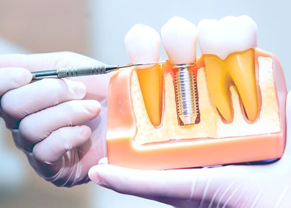 Имплантация зубов в Раменском: полный гид по ценам и услугам