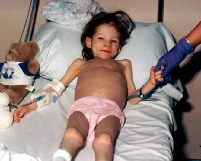 Крайне истощённая Лорен Кавано в возрасте восьми лет сразу после спасения