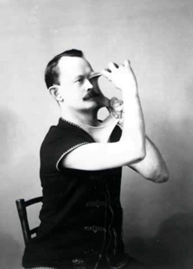 Джеймс Моррис растягивает кожу живота фото XIX век синдром Элерса-Данлоса