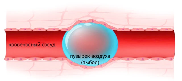 Опасная воздушная эмболия кровеносной системы