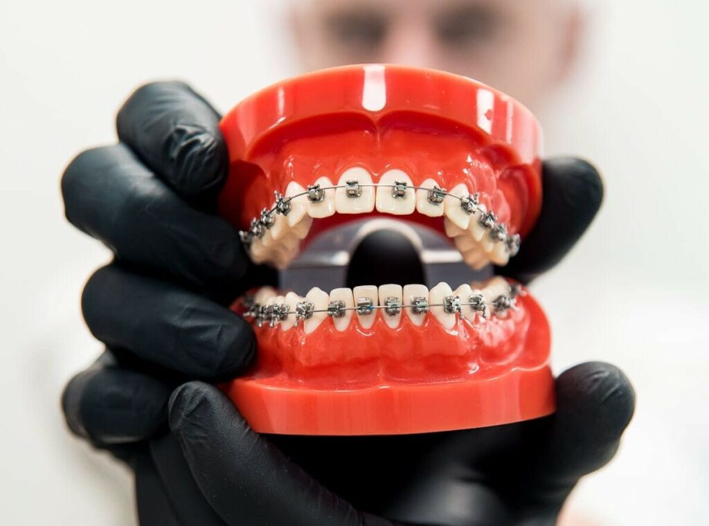 Bigpicture ru breket sistemy dlya zubov