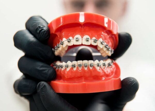 Рейтинг популярных брекет-систем и их стоимость в 2025 году