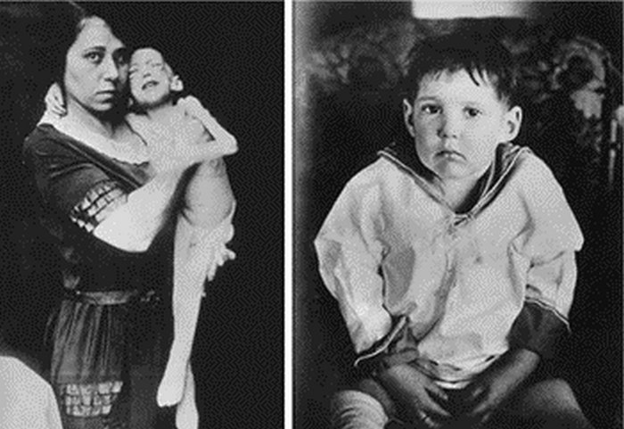 Леонард Томпсон до и после инсулиновой терапии