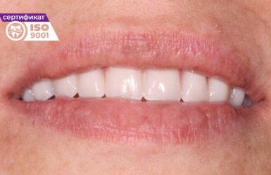 История отбеливания зубов: от древних методов до современных в Минске