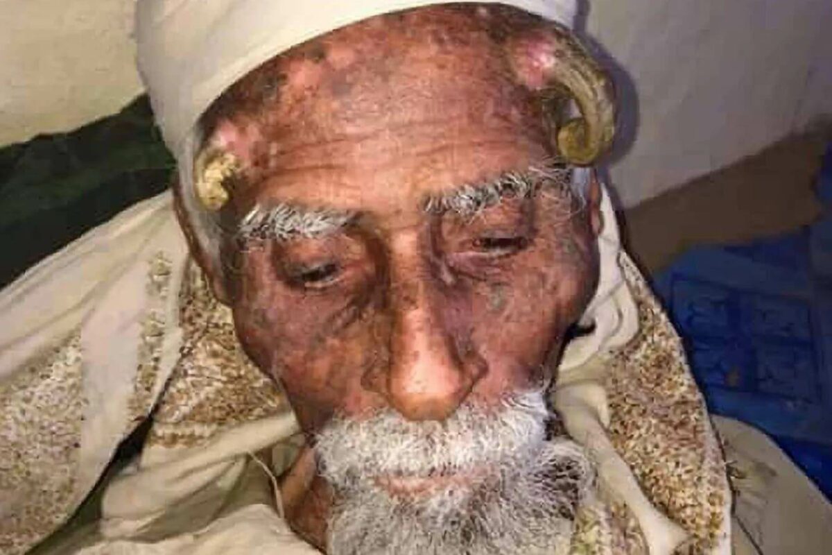 Йеменец Али Антер с двумя кожными рогами на голове