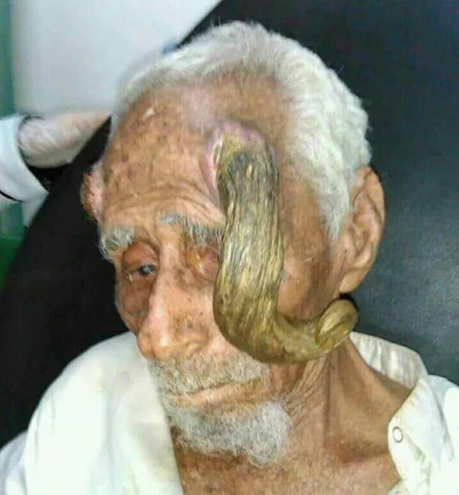 Кожный рог кератома на голове пожилого мужчины