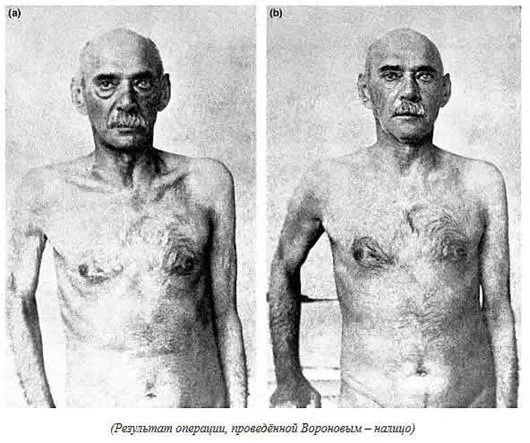 Пациент Воронова после операций по омоложению с густыми волосами на груди