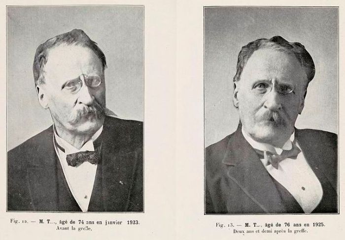 Сергей Воронов хирург результаты омоложения пациента до и после