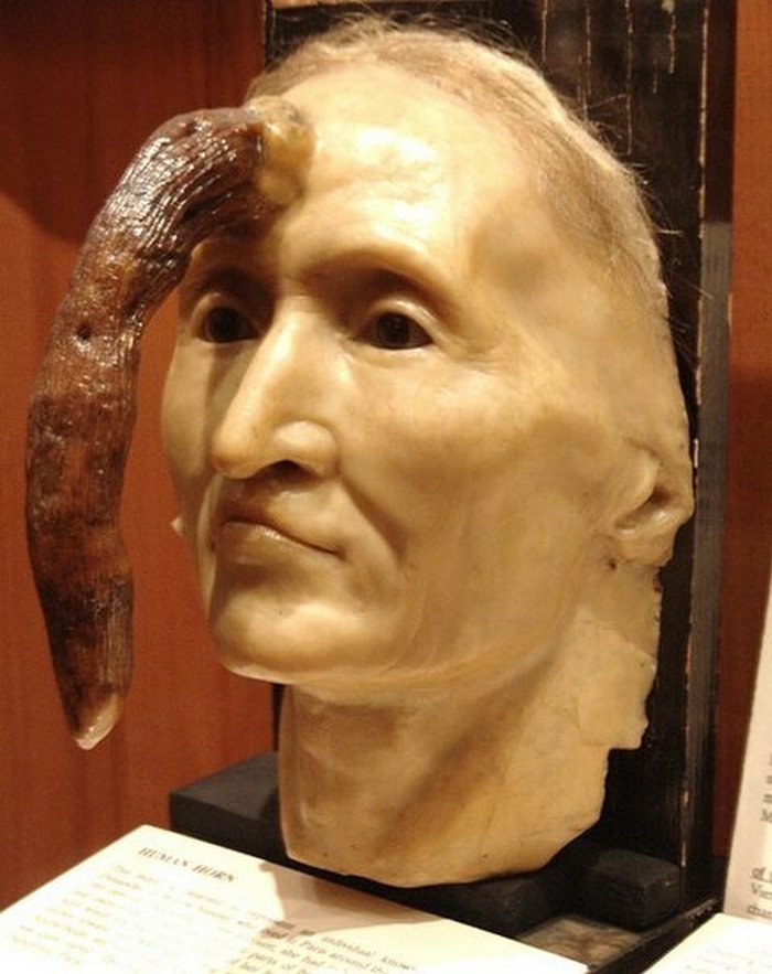 Восковая копия головы мадам Диманш с кожным рогом