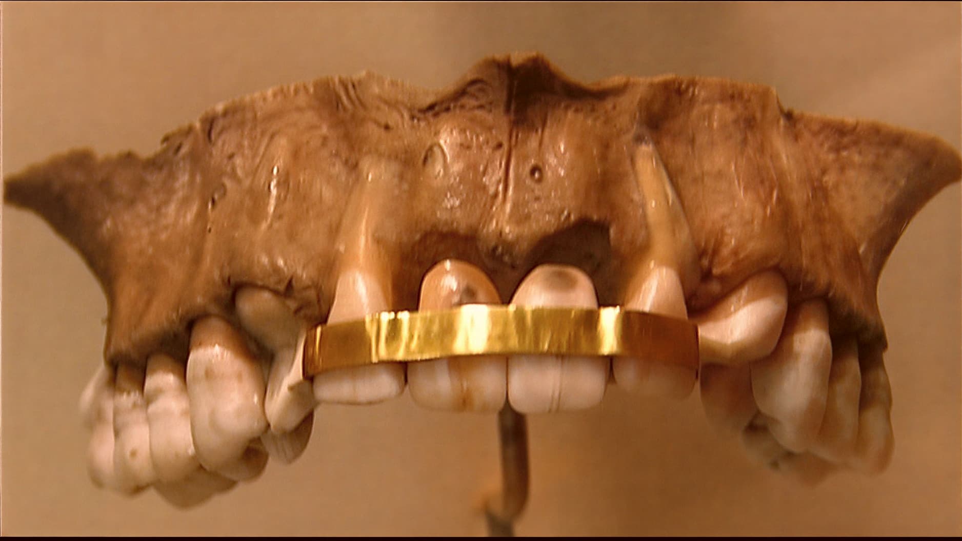 Зубной мост в Древнем Египте с золотой пластинкой