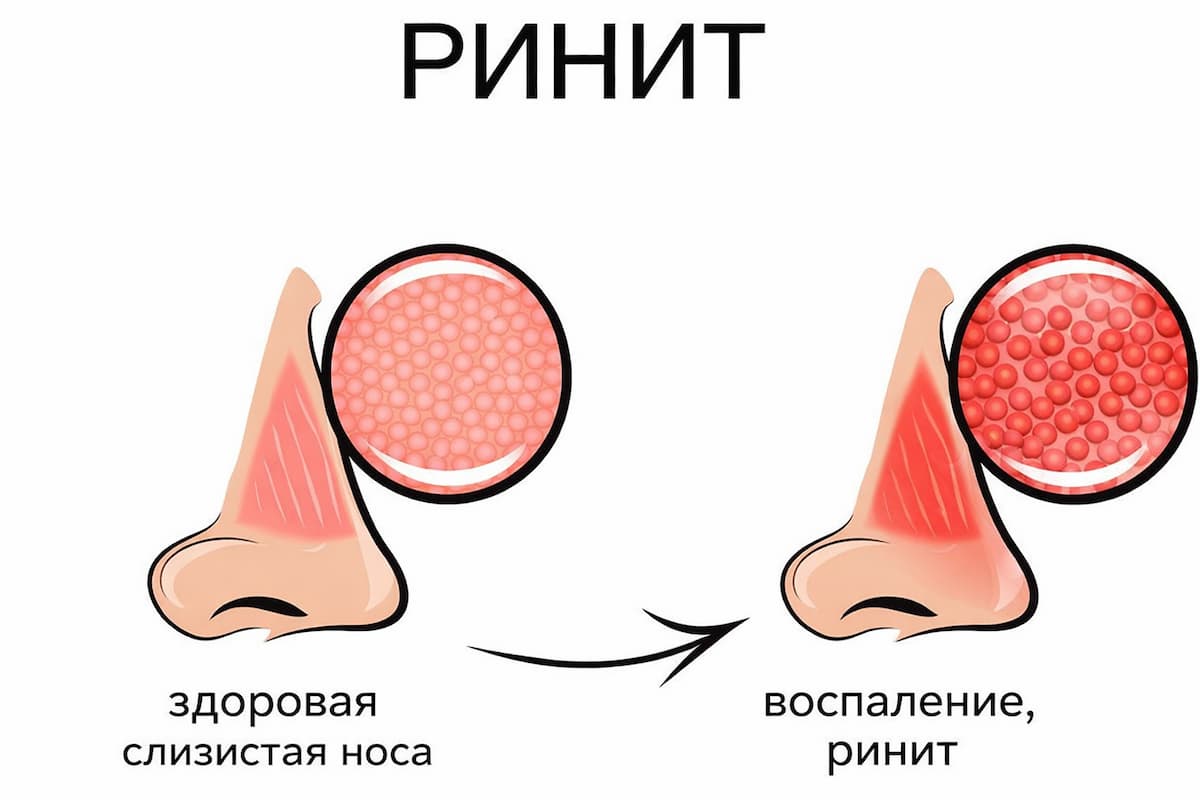 Воспаленная и здоровая слизистая оболочка носа на рисунке